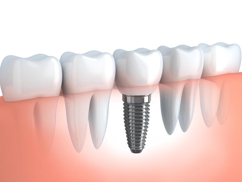 Dental Implants  Charlotte, NC 